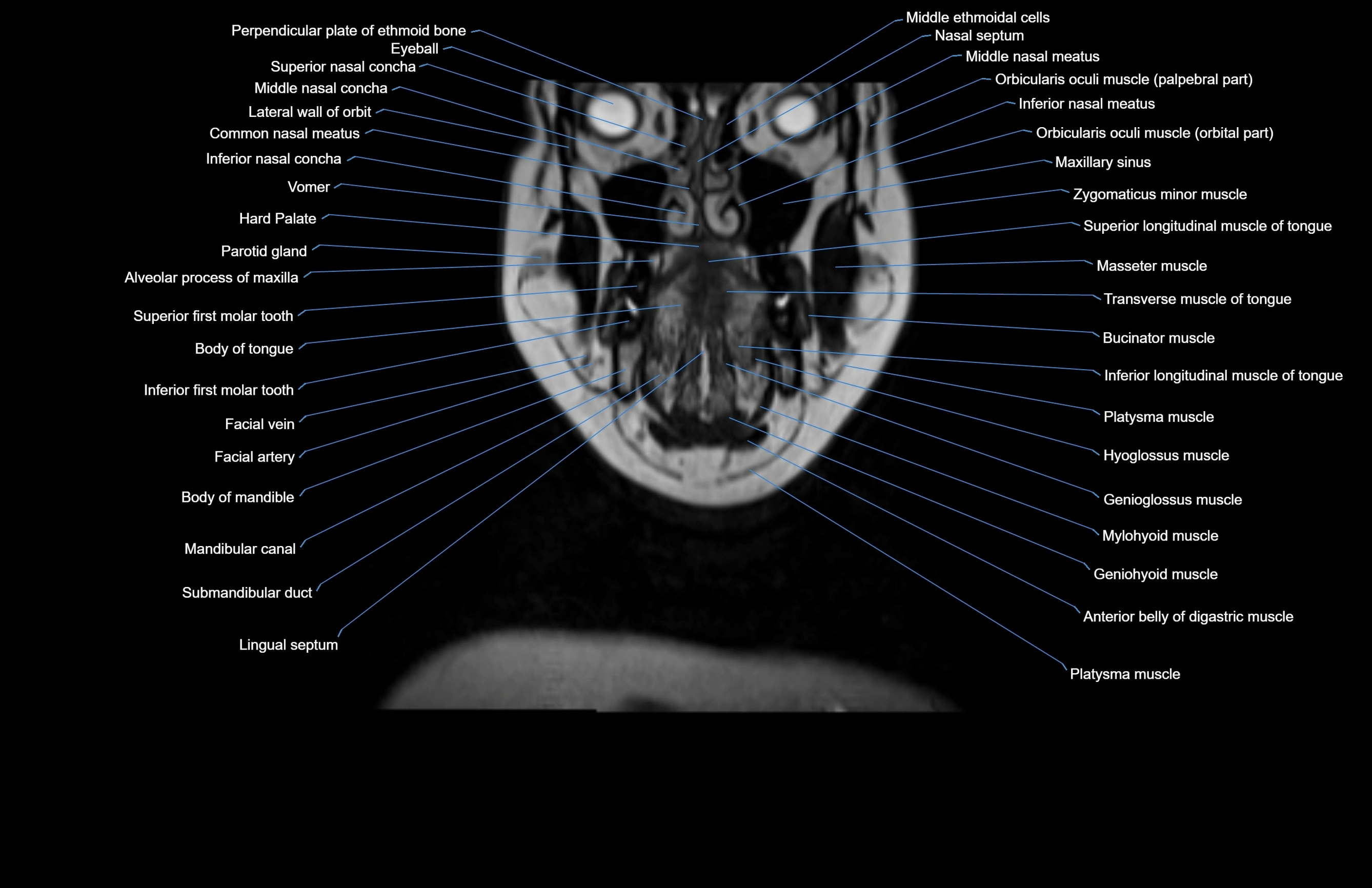 Neck coronal cross sectional MRI anatomy 3T MRI  image-img-00001-00061.webp